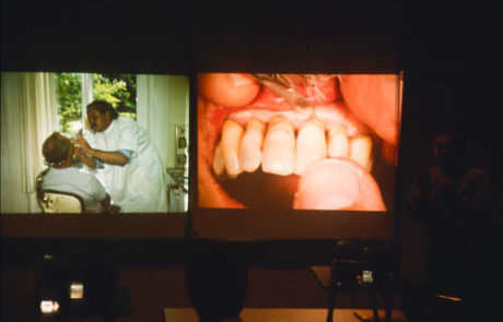 Willi Geller beim Erarbeiten des Sulkus-Effektes im Frontzahnbereich. Bei einem Vortrag auf der Denttechnika in Köln.