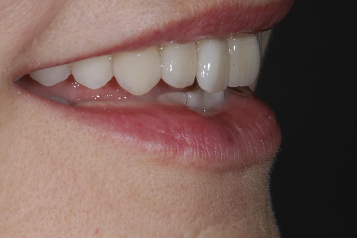 Unsere neugestalteten Zähne im Detail.