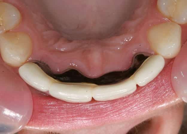 Kronen & Brücken, Zahnimplantate, Zahnprothesen - Zahnersatz