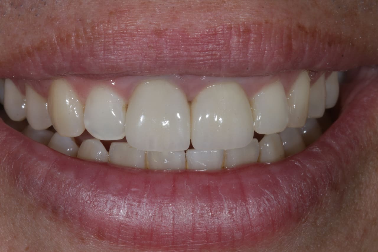 Zahnersatz und Zahnprothesen - 20