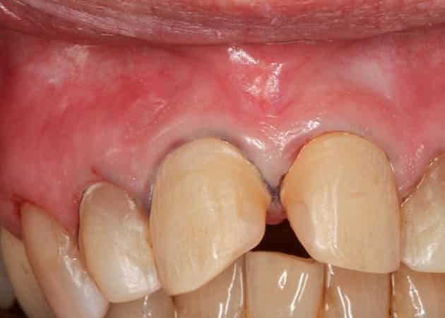 Minimalinversive Präperation der Zähne. Vorbereitung für die Veneers.