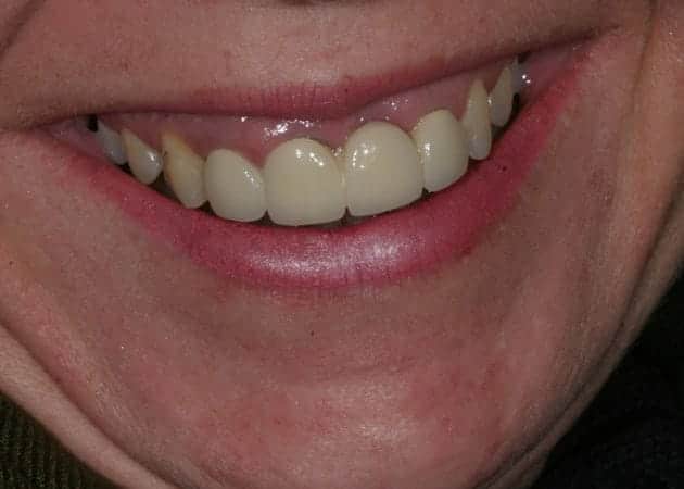 Kronen & Brücken, Zahnimplantate, Zahnprothesen - Zahnersatz