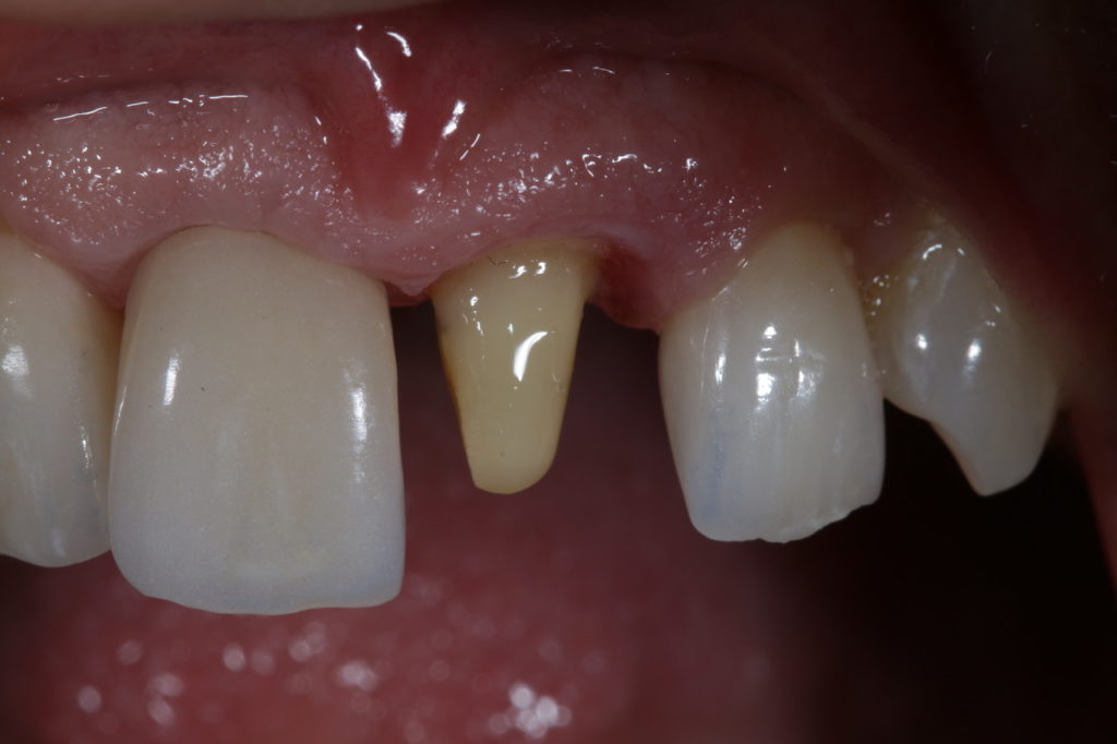 Zähne vorstehende Vorstehende Zähne