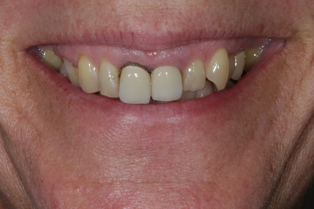 Veneers / Kronen vorher