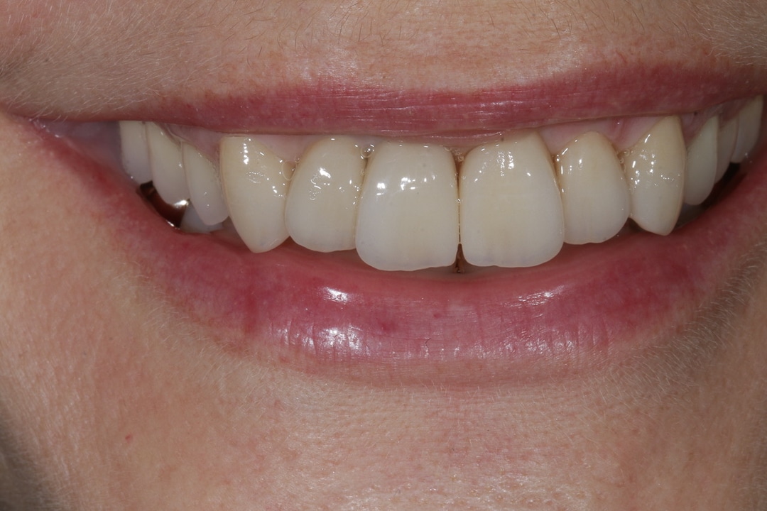 Veneers / Kronen nachher