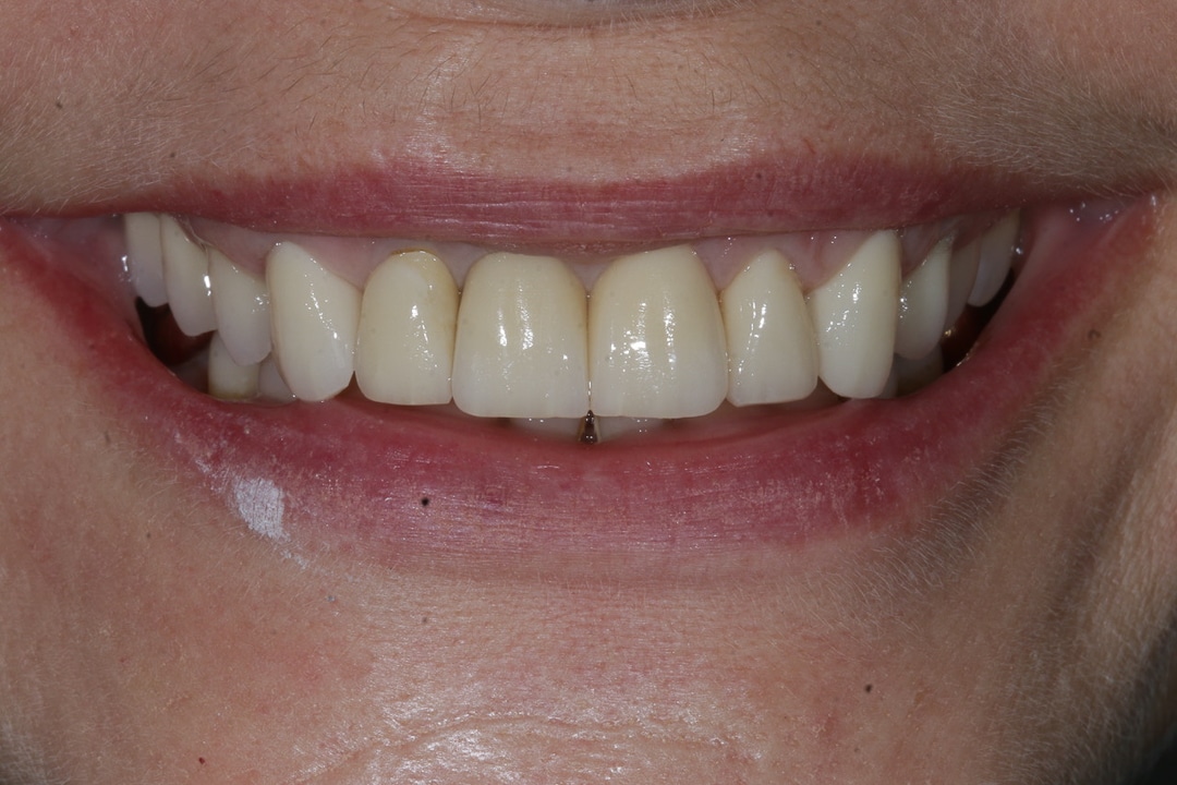 Veneers / Kronen vorher