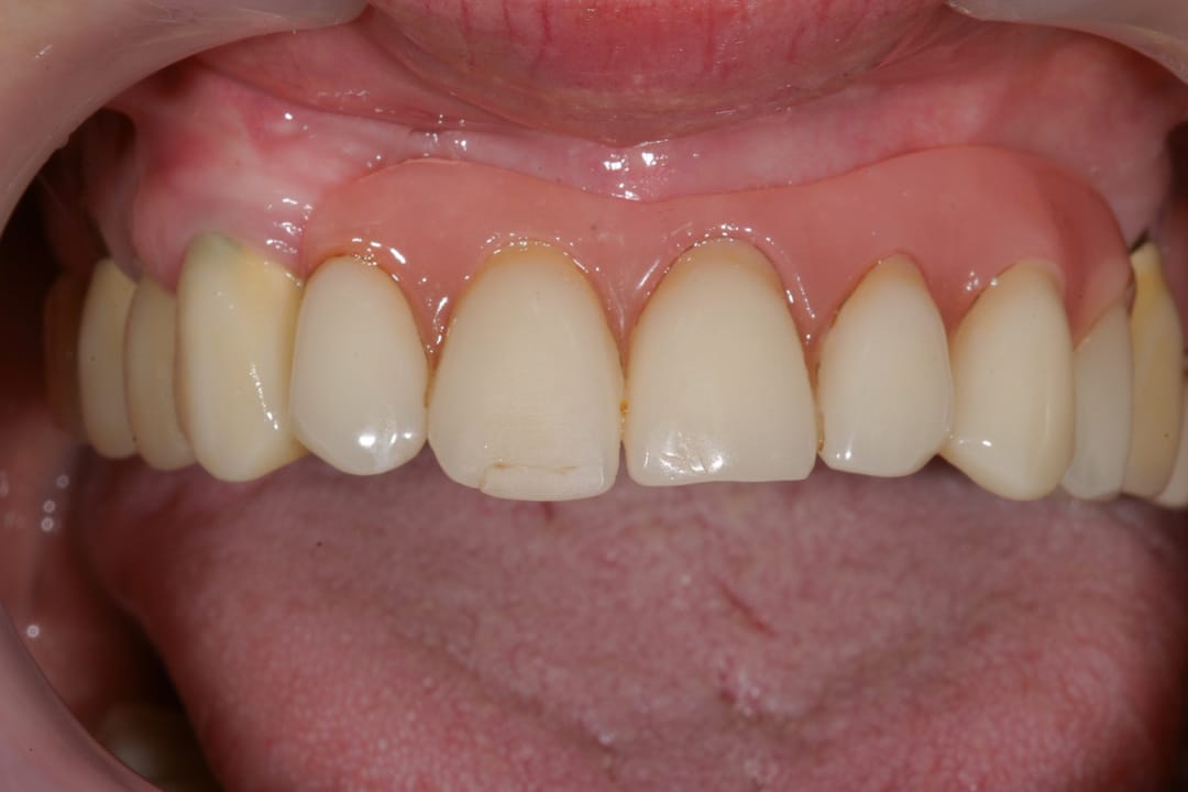 Zahnprothese vorher