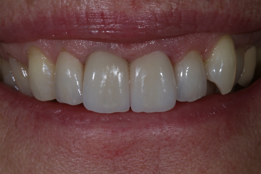 Veneers / Kronen nachher