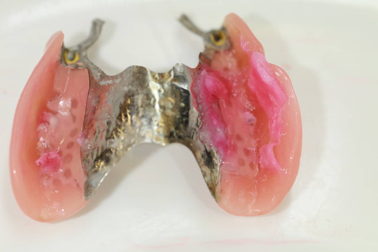 Die ursprüngliche Prothese war nur ungenügend mit Haftcreme im Mund fixierbar.